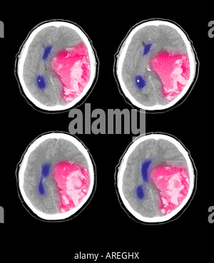 CT scan immagini che mostrano un ictus emorragico in una 73 anno vecchio Foto Stock