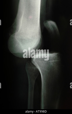 X-ray, la dislocazione ossea dopo incidente Foto Stock