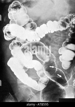 Il bario x ray grande polipo rettale Foto Stock