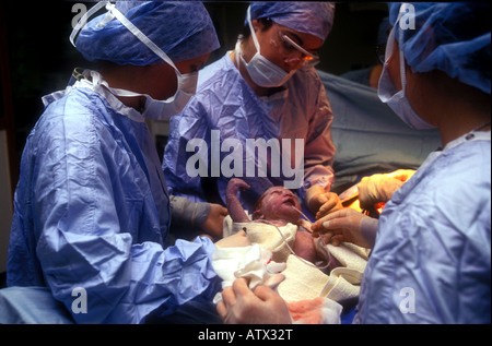 Baby sollevato dallo stomaco durante il taglio cesareo nascita Londra Foto Stock