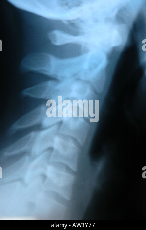 X-ray fotografia di scheletro umano Foto Stock