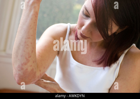 Donna con rash sul suo braccio Foto Stock