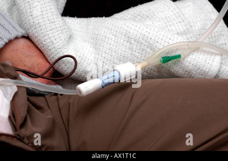 Sacchetto CAPD exchange Foto Stock