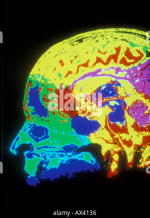 Raggi x del cranio umano con codice colore Foto Stock