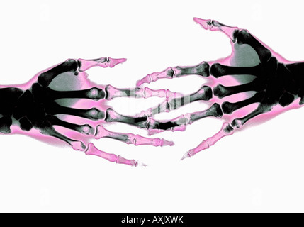 Stretta di mano dopo accordo x ray delle mani Foto Stock