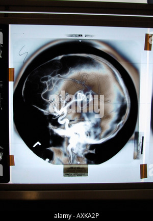 raggi x del cervello Foto Stock