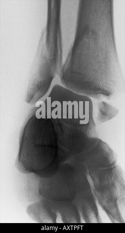 Raggi x di un bimalleolar caviglia frattura che mostra si rompe in entrambe parte distale della tibia e perone Foto Stock