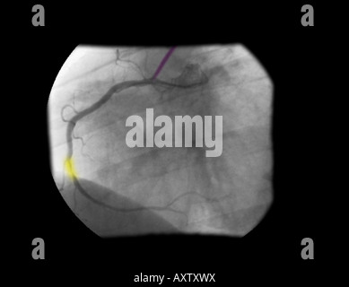 In modo digitale avanzata, colorizzato raggi x di un angiogramma coronarico la stenosi dell'arteria coronaria destra Foto Stock