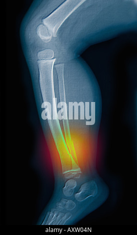 Raggi x della parte inferiore della gamba di un giovane bambino che mostra una frattura da abuso di minori Foto Stock
