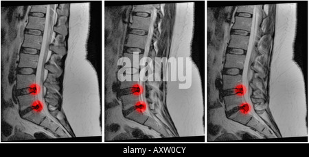 MRI della colonna vertebrale su 29 anni di sesso femminile che hanno sviluppato dolore alla schiena dopo la piegatura. La MRI scan mostra ernia, dischi di rigonfiamento Foto Stock