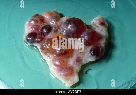 Ovaia policistica Foto Stock