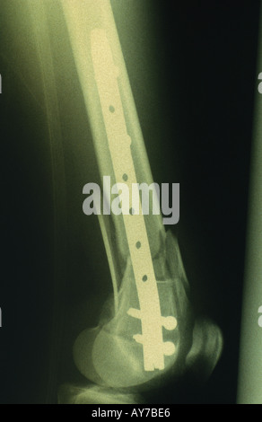 X ray femore fratturato con supracondylar chiodo Foto Stock