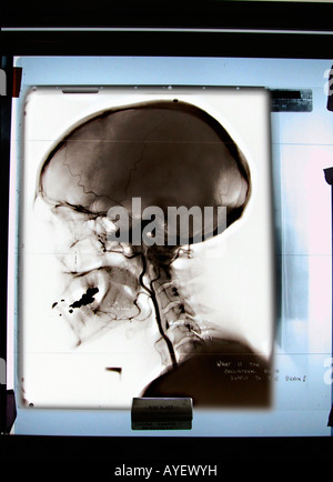 X ray di scull e collo Foto Stock
