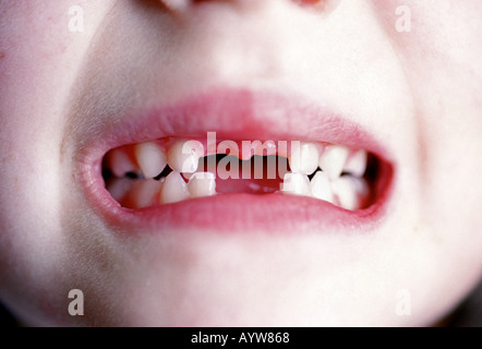 Una giovane ragazza che mostra la sua anteriore mancanti due denti superiori e inferiori Foto Stock