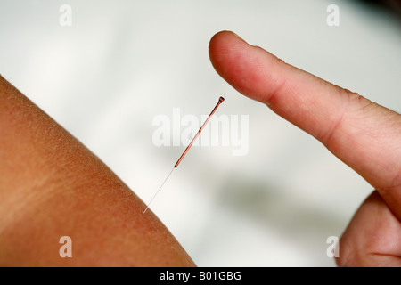 Agopuntura, ago nel paziente del gomito Foto Stock
