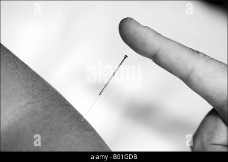 Agopuntura, bianco e nero, l'ago nel paziente del gomito Foto Stock