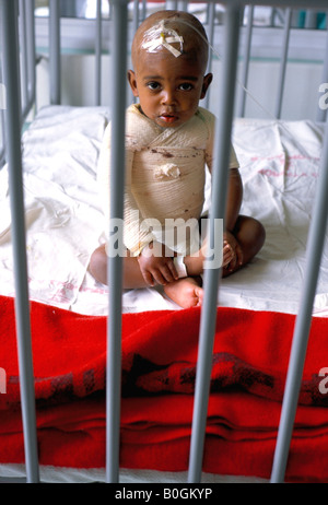 Un ritratto di un bambino nella culla al reparto ustionati a Soweto Ospedale, Soweto, Sud Africa. Foto Stock