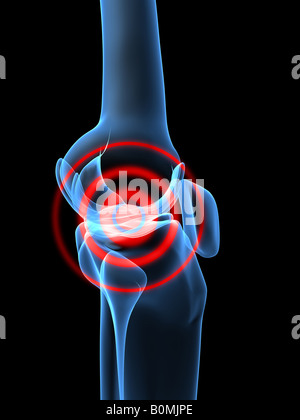 Infiammazione del ginocchio Foto Stock