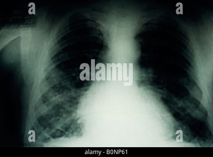 Polmone nero, i raggi X al torace di un russo minatore di carbone che soffrono di nero una malattia polmonare. Il minatore morto dopo questo X ray è stato preso. Foto Stock