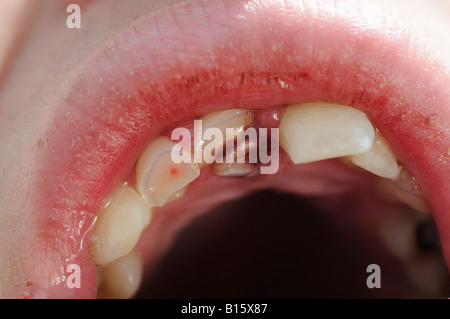 Denti rotti e split lip dopo essere stato attaccato in bar Foto Stock