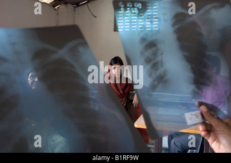 Ragazza, la tubercolosi paziente indurito dopo sei mesi di trattamento, il follow-up il check-up, raggi x, quella di Howrah, Hooghly, West Bengal, India Foto Stock