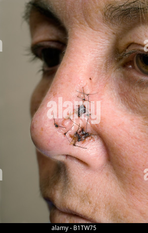 Quattro giorni dopo un intervento chirurgico su di un naso per rimuovere una cellula basale sarcoma Foto Stock