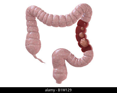 tumore del colon Foto Stock