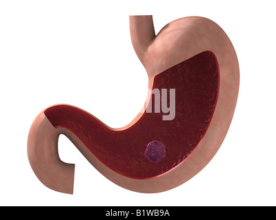 ulcera allo stomaco Foto Stock