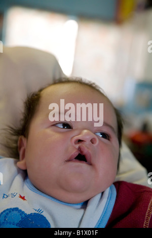 Nogales Messico un bambino con una palatoschisi Foto Stock