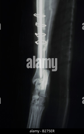 X RAY cane s gamba tondino in acciaio chirurgia ricostruttiva Foto Stock