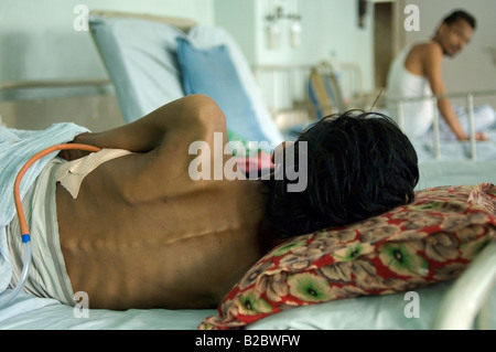 Retro di un criticamente malato l uomo che soffre di TB in Shree ospedale di Jain, polmone scaricare collocato nella sua cassa toracica, il suo trattamento è f Foto Stock