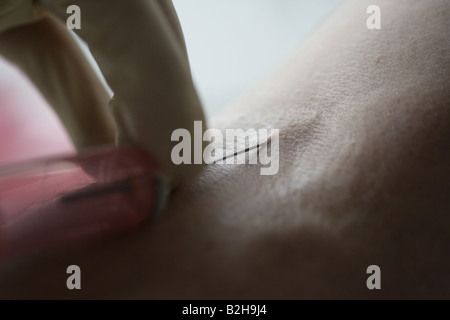 La donazione di sangue per le cellule staminali Foto Stock
