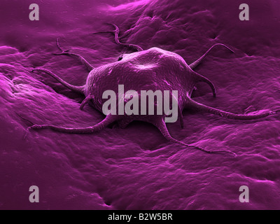 cellula tumorale Foto Stock