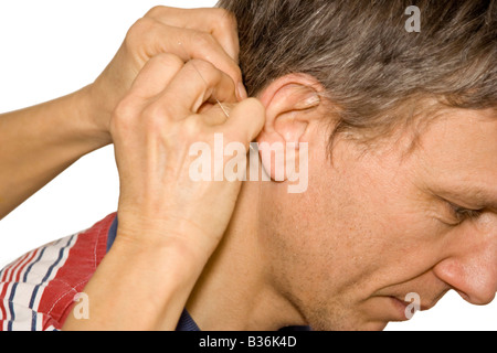 Agopuntura - trattamento medico donna applicando aghi di agopuntura dietro un uomo l orecchio Foto Stock