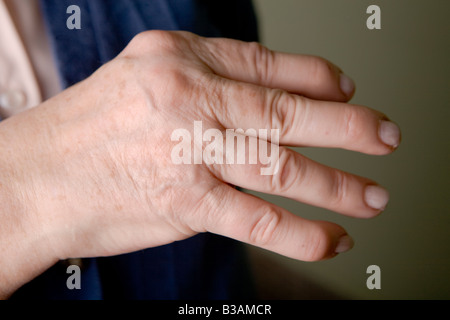 Artropatia psoriasica mani di una donna di 60 anni Foto Stock