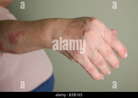 Artropatia psoriasica mani di una donna di 60 anni Foto Stock