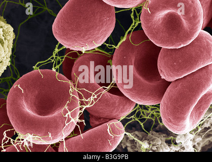 Di coagulo di sangue, colorata di microfotografia electron scansione (SEM). Foto Stock
