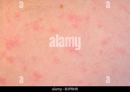 Allergia cutanea causata da una intolleranza alla penicillina Foto Stock