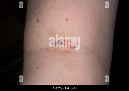 Lesione sinistra dopo un campione di sangue prelevato il flash ad anello Foto Stock