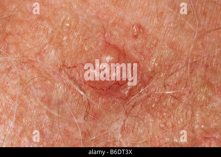 Il cancro della pelle nodulari carcinoma basocellulare (BCC) sul petto Foto Stock