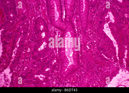 Micrografia di luce di una sezione attraverso un adenocarcinoma del colon sigmoide, parte dell'intestino crasso. Foto Stock