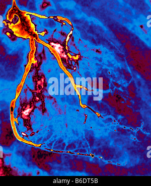 Restringe le arterie coronarie. Coronaryangiogram colorati (X-ray) di 59 anno vecchio paziente. Foto Stock