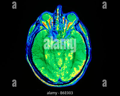 Falso colore di immagini a risonanza magnetica (MRI) della sezione anaxial attraverso una testa umana. Foto Stock