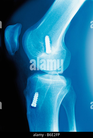 Legamento Crociato Anteriore riparazione. Profilo colorato X-ray di dispositivi di fissaggio (bianco) nelle ossa del ginocchio. Foto Stock