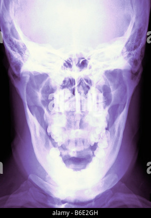 Cranio normale, frontale colorata X-ray. Foto Stock