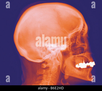 Cranio normale. Profilo colorato X-ray del cranio. Foto Stock