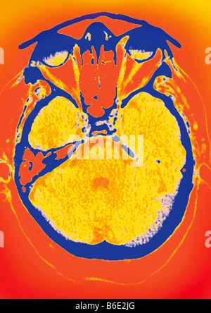 Cervello normale, colorata assiale (in sezione trasversale) tomografia computerizzata (CT) scansione. Foto Stock