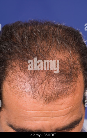 Uomo di mezza età balding Foto Stock