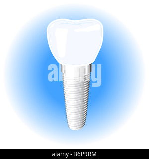 Impianto dentale Foto Stock