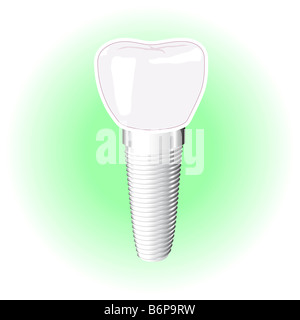 Impianto dentale Foto Stock
